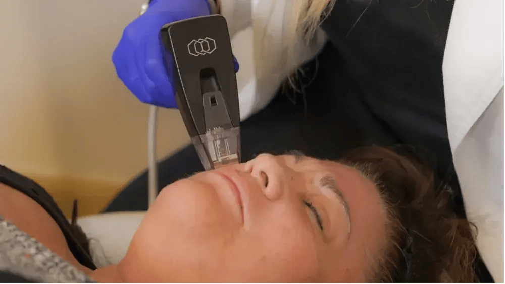 Microneedling