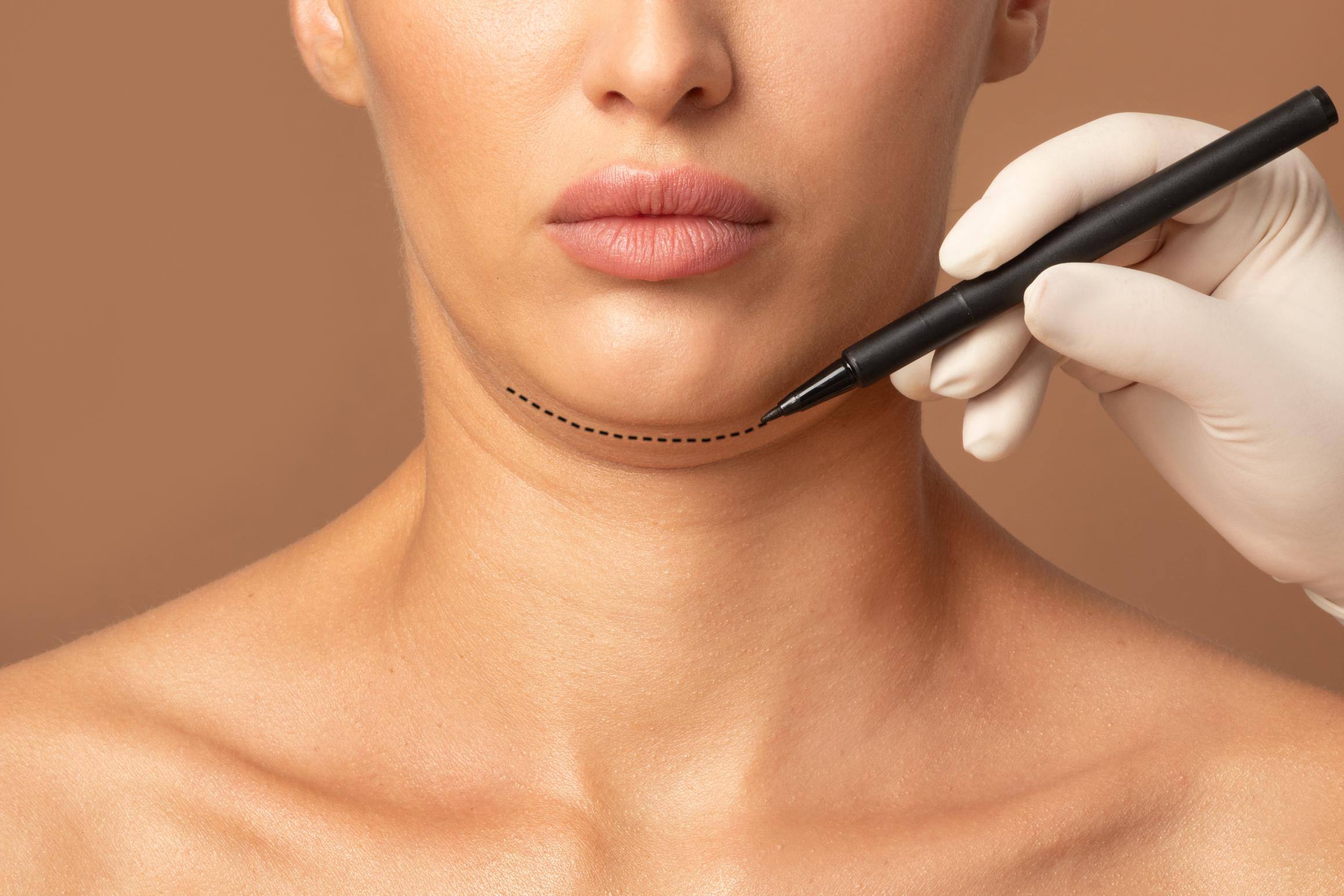 kybella_826482620